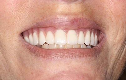 Smile gallary image - After